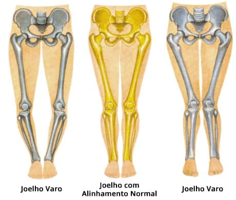 artrose do joelho alinhamento corporal fisiatria