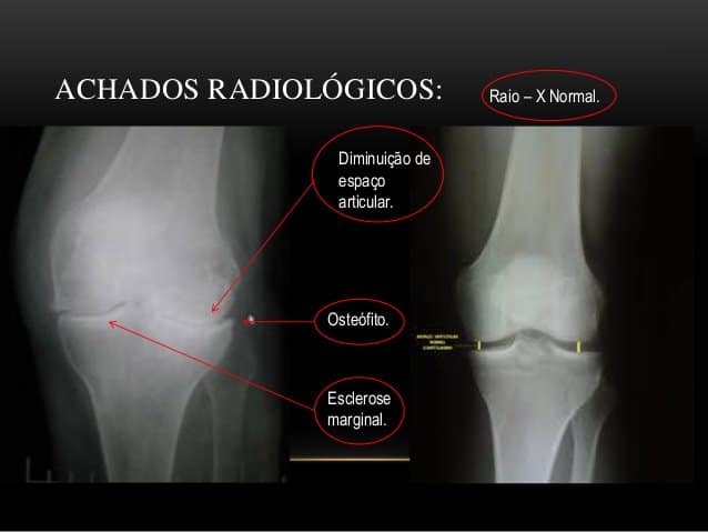 raio-x de joelho osteoartrose