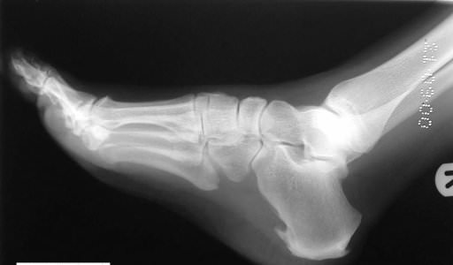 esporao de calcaneo dor no pe