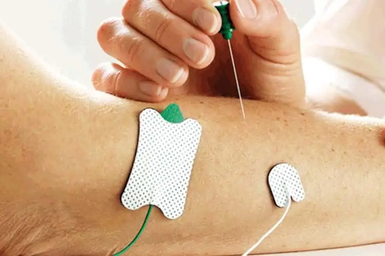 Síndrome dos Pés Ardentes - Queimação nos Pés 2 eletroneuromiografia para polineuropatia diabetica