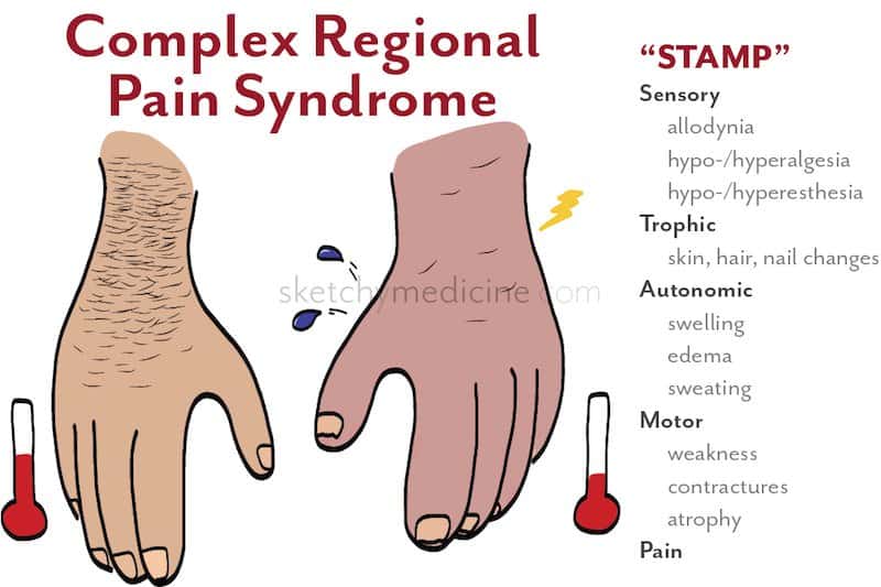 sindrome complexa de dor regional esquema