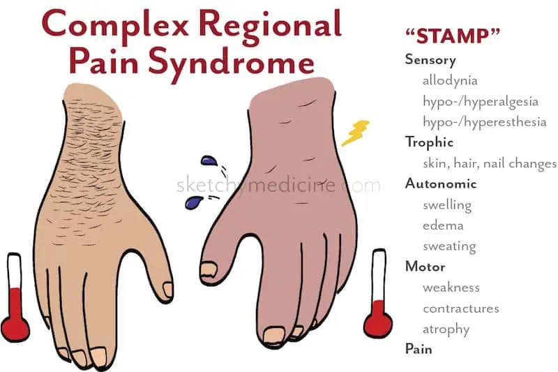 Aprenda mais sobre a Síndrome Complexa de Dor Regional 1 sindrome complexa de dor regional esquema