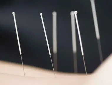 acupuntura-chinesa