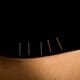 Acupuntura pode prevenir boca seca (xerostomia) induzida por radioterapia, segundo estudo