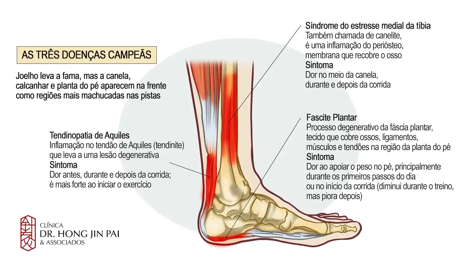 Causas comuns de dor nas pernas e pés