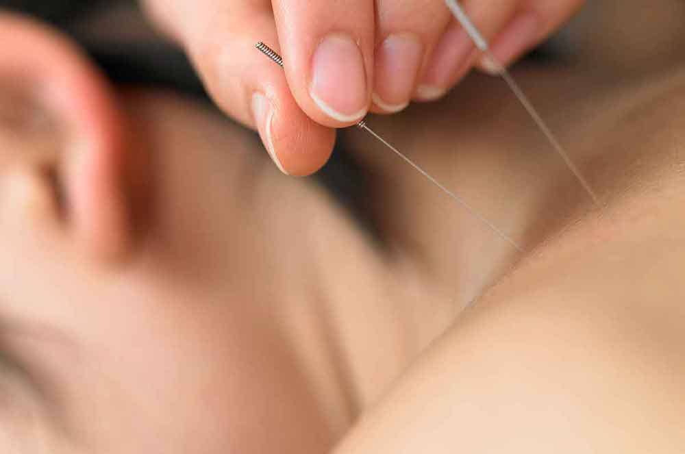 acupuntura agulhamento seco