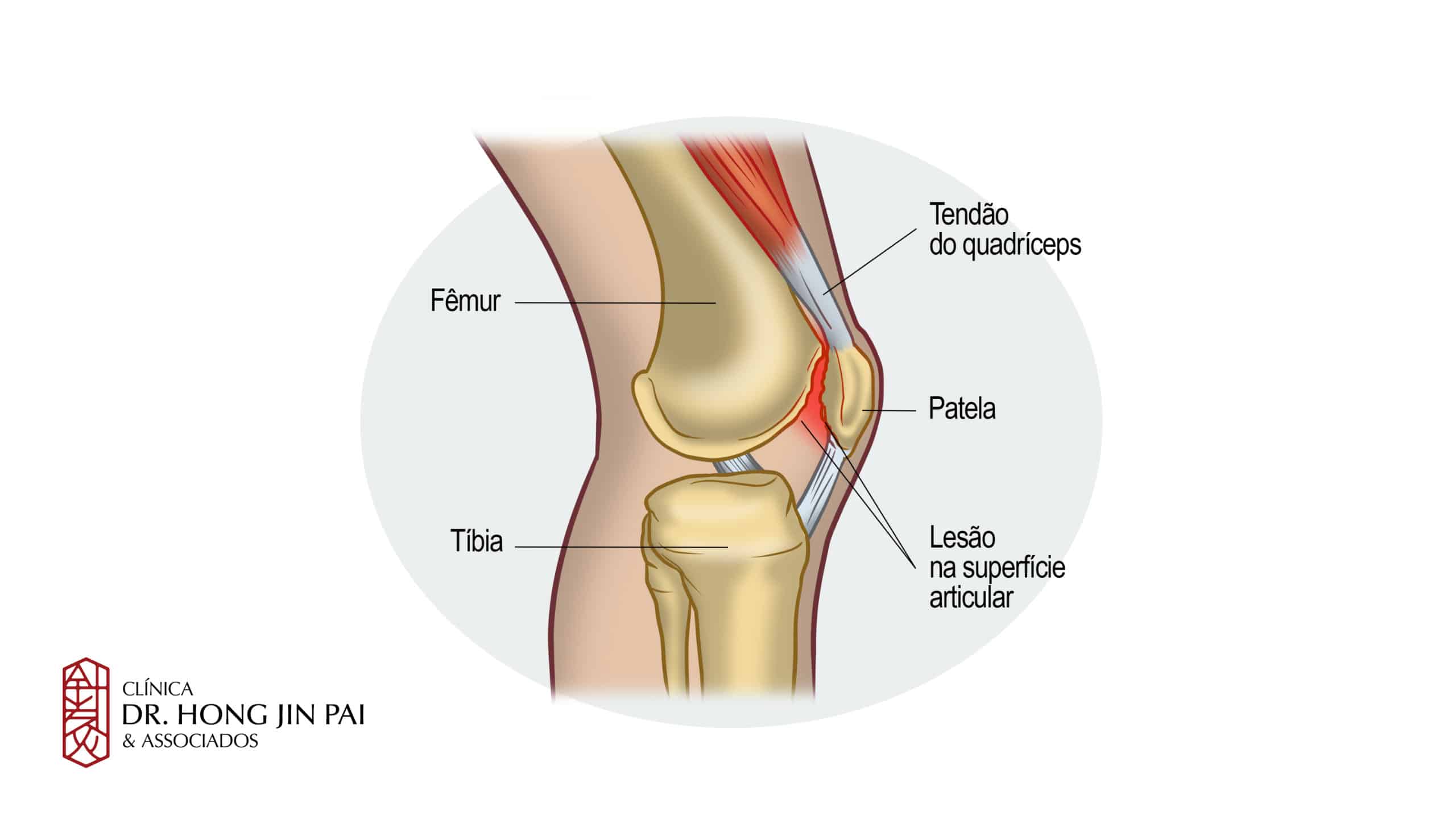 A Síndrome da Dor Femoropatelar é uma das desordens mais frequentes do joelho, caracterizada por dor anterior no joelho