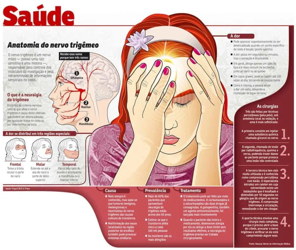 O que é Neuralgia do trigêmeo? O que causa a Neuralgia do trigêmeo? 1 image10