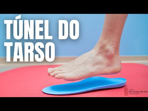 SÍNDROME DO TÚNEL DO TARSO - Dor no tornozelo e pé. Aprenda mais #fisiatria #dor