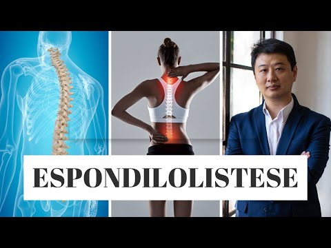 Coluna travada pode ser Espondilolistese? Escorregamento vertebral -Aprenda mais #coluna