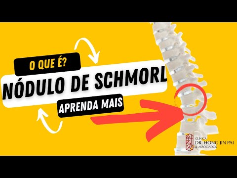 Nódulo de Schmorl: o que é, sintomas, causas e tratamento