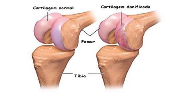 osteoartrose de joelho primaria