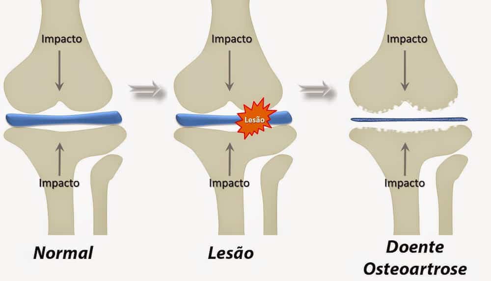 osteoartrose ilustracao de joelhoi