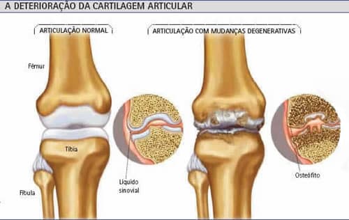 osteoartrose joelho articulacao anatomia