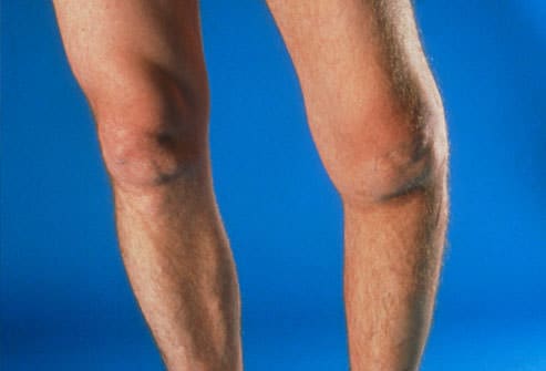 osteoartrose joelho sinais visiveis