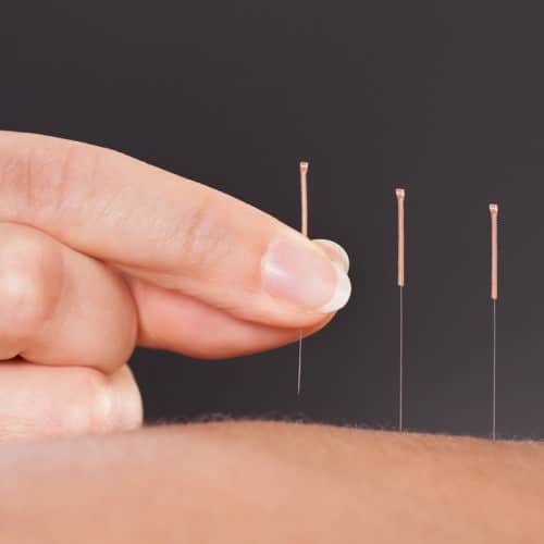 Tratamento por Acupuntura na Clinica Dr Hong Jin Pai