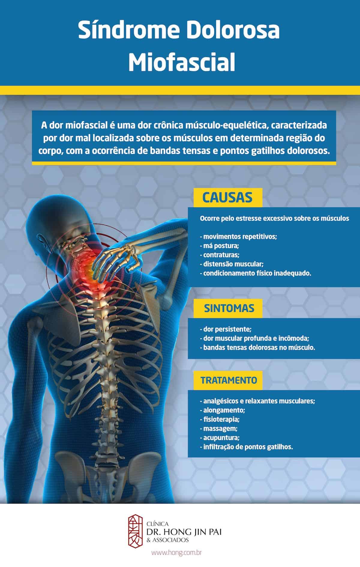 SDM sindrome dolorosa miofascial ou dor miofascial