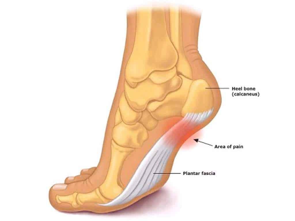 Diagrama anatômico do pe em corte lateral mostrando o calcâneo (osso do calcanhar), a fáscia plantar em branco estendida até os dedos e uma área de dor destacada em vermelho na inserção da fáscia no calcanhar.