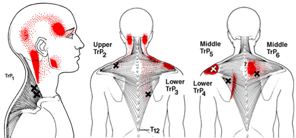 Sindrome Dolorosa Miofascial no Trapezio