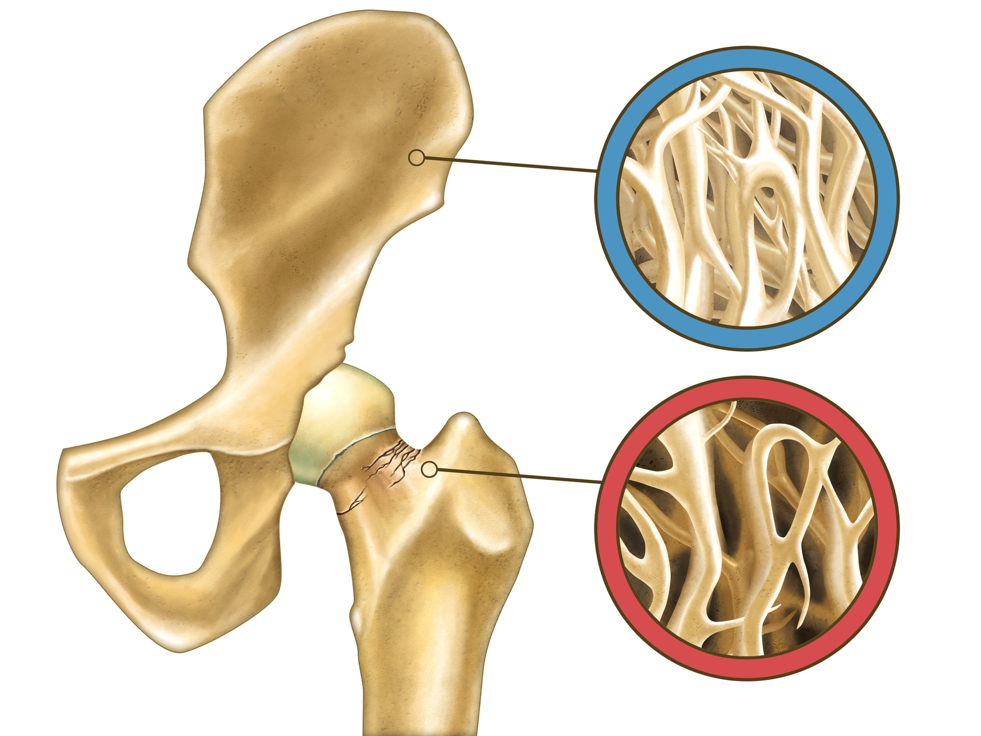 Osteoporose e perda da massa óssea