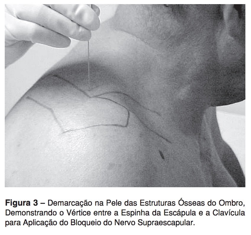 No para pescoço ombro tratamento e músculos puxados melhor