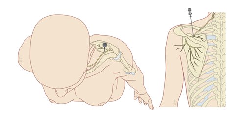 Ilustração de uma pessoa de costas recebendo agulha na região do ombro, com detalhe do trajeto do nervo supraescapular sobre a escápula.