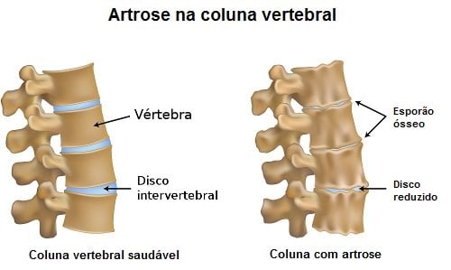 coluna vertebral e artrose
