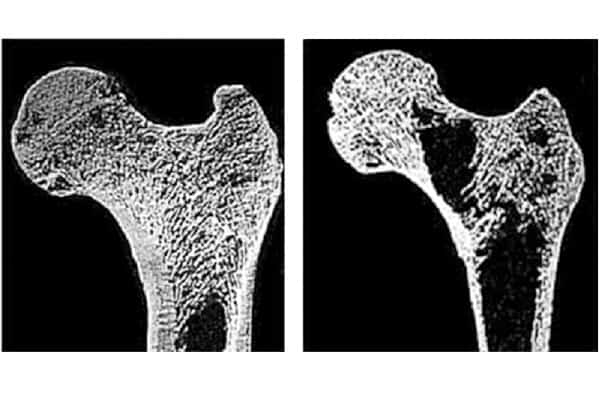 Duas imagens radiograficas de femures lado a lado: a esquerda com osso denso e uniforme, a direita com osso escurecido e rarefeito pela osteoporose.