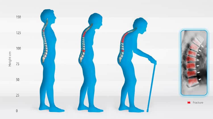 Três silhuetas em perfil mostrando perda progressiva de altura e curvatura da coluna por fraturas vertebrais, com radiografia destacando vértebras fraturadas.