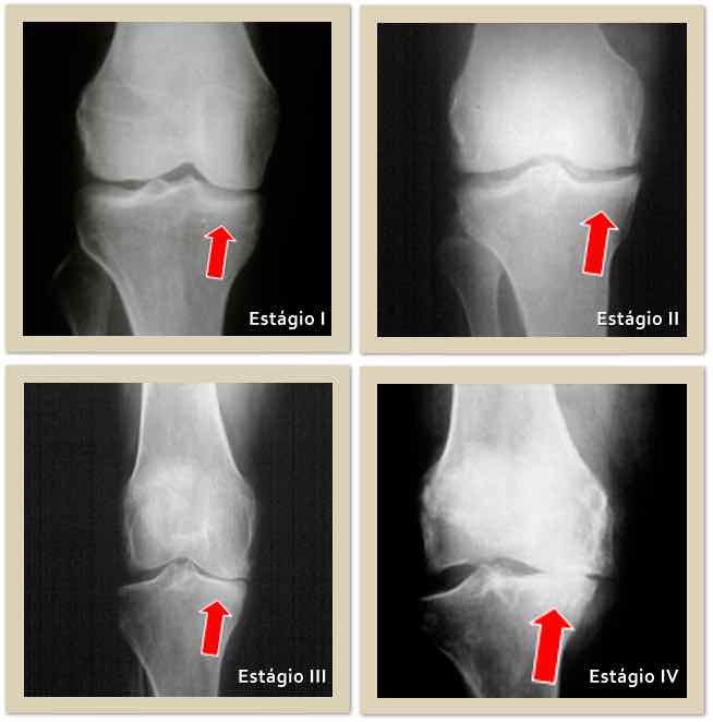 radiografia osteoartrose