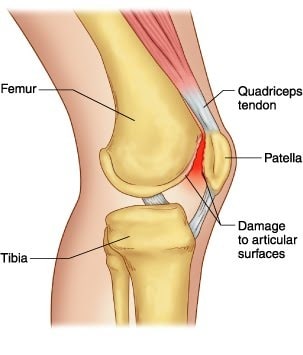 Corte lateral do joelho mostrando fêmur, tíbia, patela e tendão do quadríceps, com a cartilagem atrás da patela marcada em vermelho indicando lesão da superfície articular.