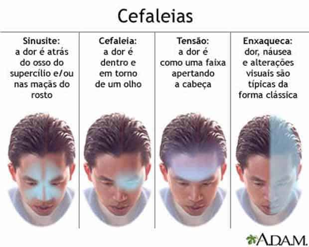 tipos de cefaleia