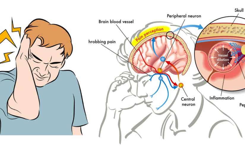 Diagrama do cérebro com a via neural da dor da enxaqueca, indicando percepção da dor, dilatação de vaso e inflamação.