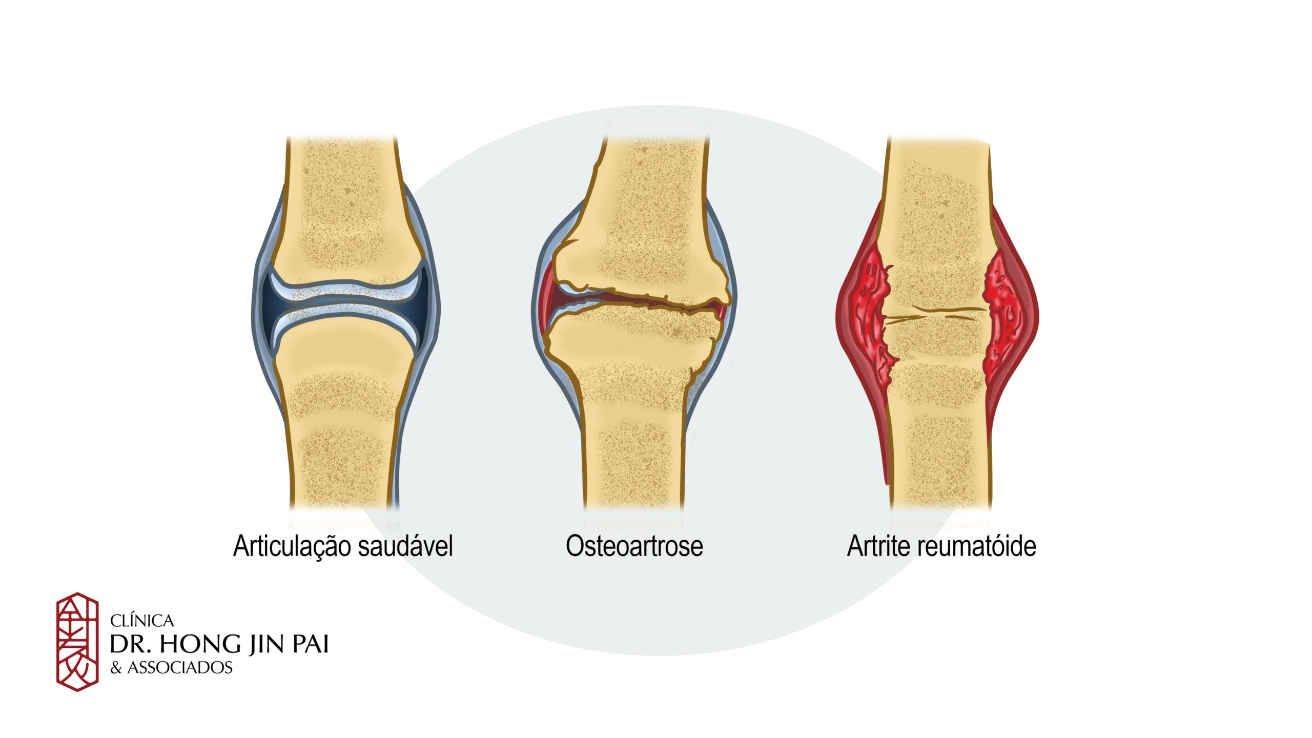 Articulacao saudavel e com artrite