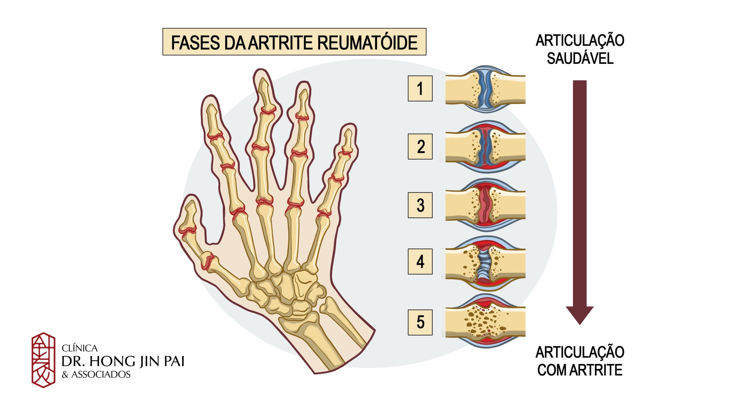 artrite reumatoide é mais comum em mulheres na faixa dos 30 aos 50 anos. Hoje se sabe que seus danos não se limitam às juntas.