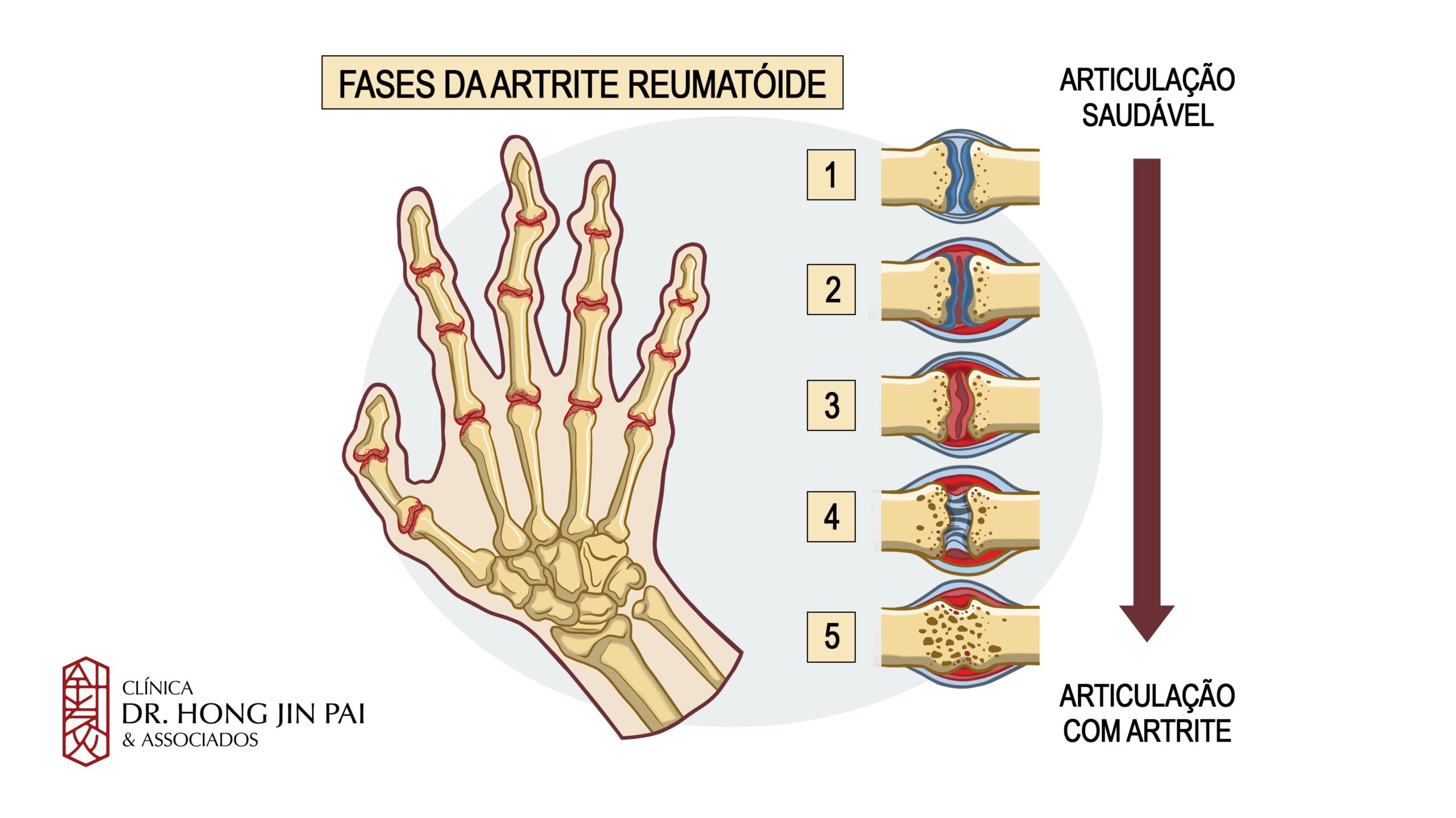 10 maneiras de aliviar a dor da artrite reumatoide Clínica Dr Hong