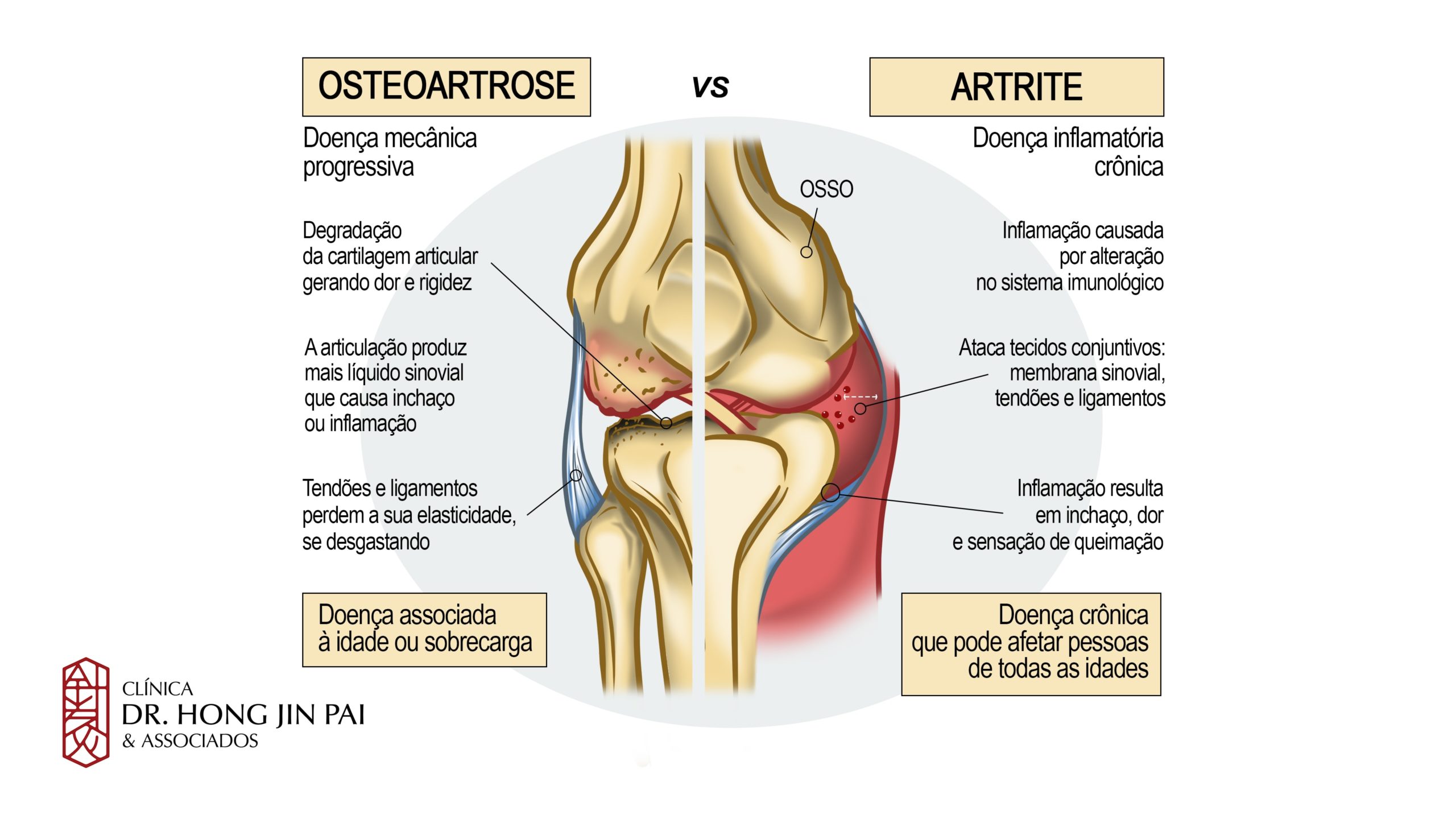 Diferencas artrose artrite reumatoide