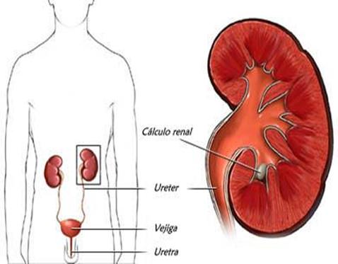 calculo renal pode resultar em dor lombar