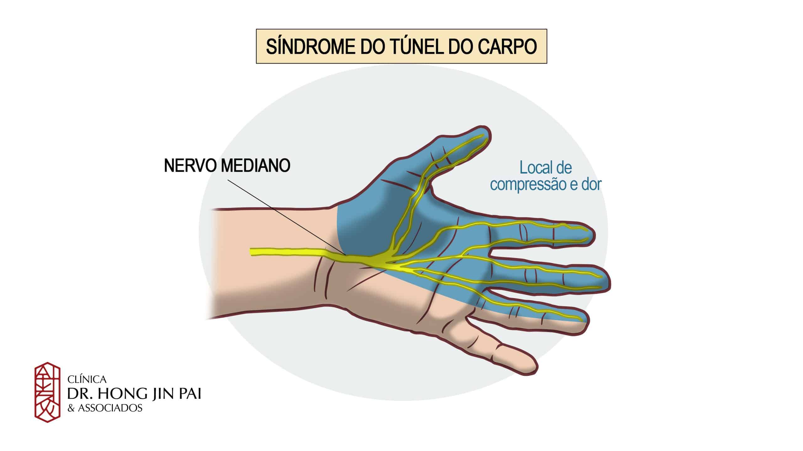 SINDROME DO TUNEL DO CARPO SINTOMAS MEDIANO scaled