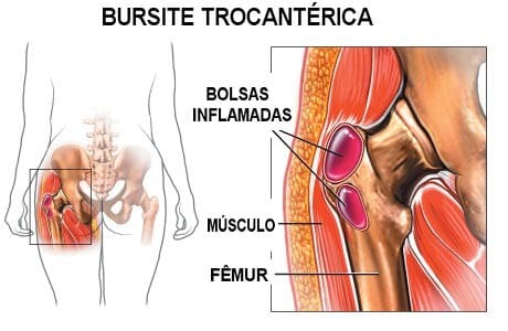 anatomia da bursite trocanterica