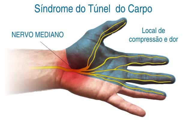 aprenda mais sobre a sindrome do tunel do carpo