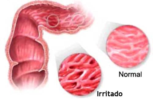 aprenda sobre acupuntura na sindrome do intestino irritavel