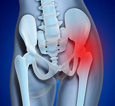 area de dor e inflamacao da bursite trocanterica