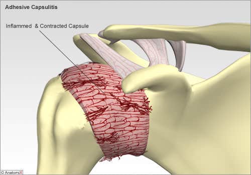 Capsulite Adesiva: ombro congelado 2 capsulite adesiva acupuntura sp