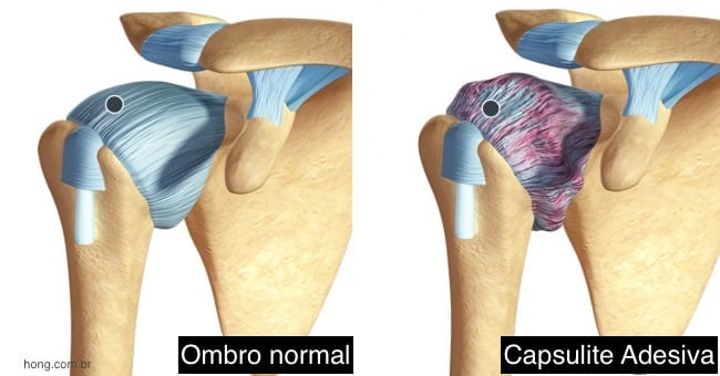 capsulite adesiva dor no ombro congelado