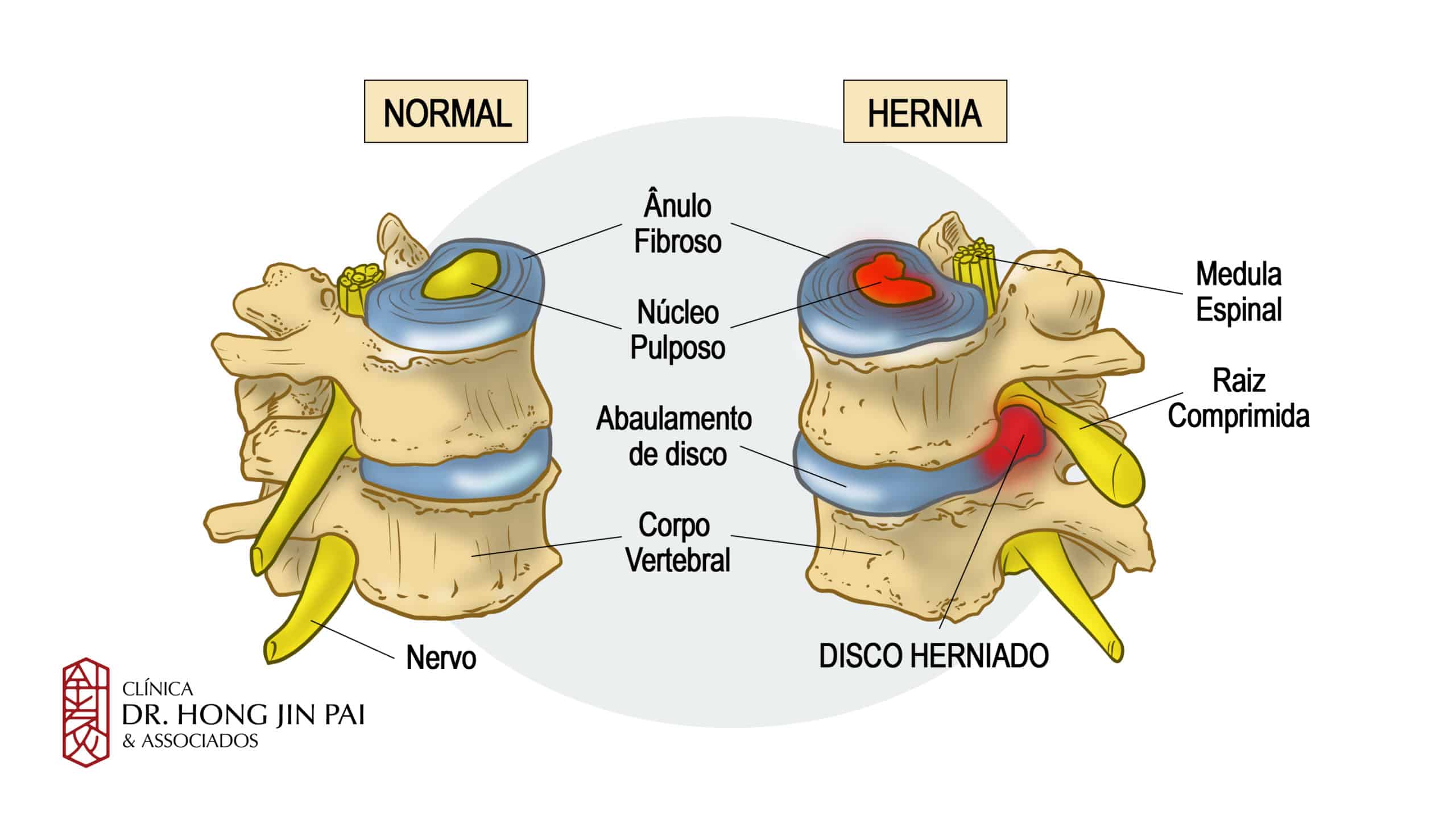 disco normal e hernia de disco na coluna