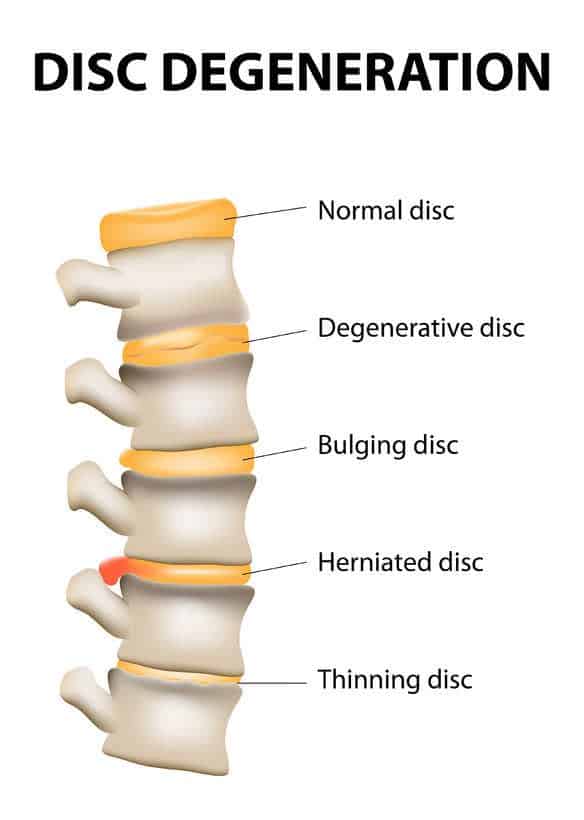 Diagrama de cinco vértebras empilhadas mostrando disco normal, disco degenerado, disco protruso, disco herniado e disco afinado, com legendas.