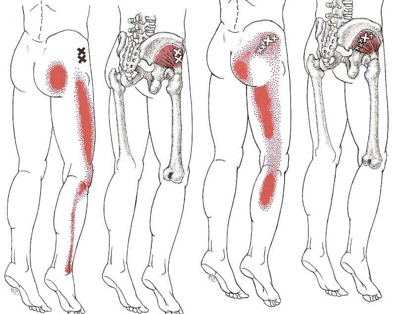 dor miofascial quadril e gluteos