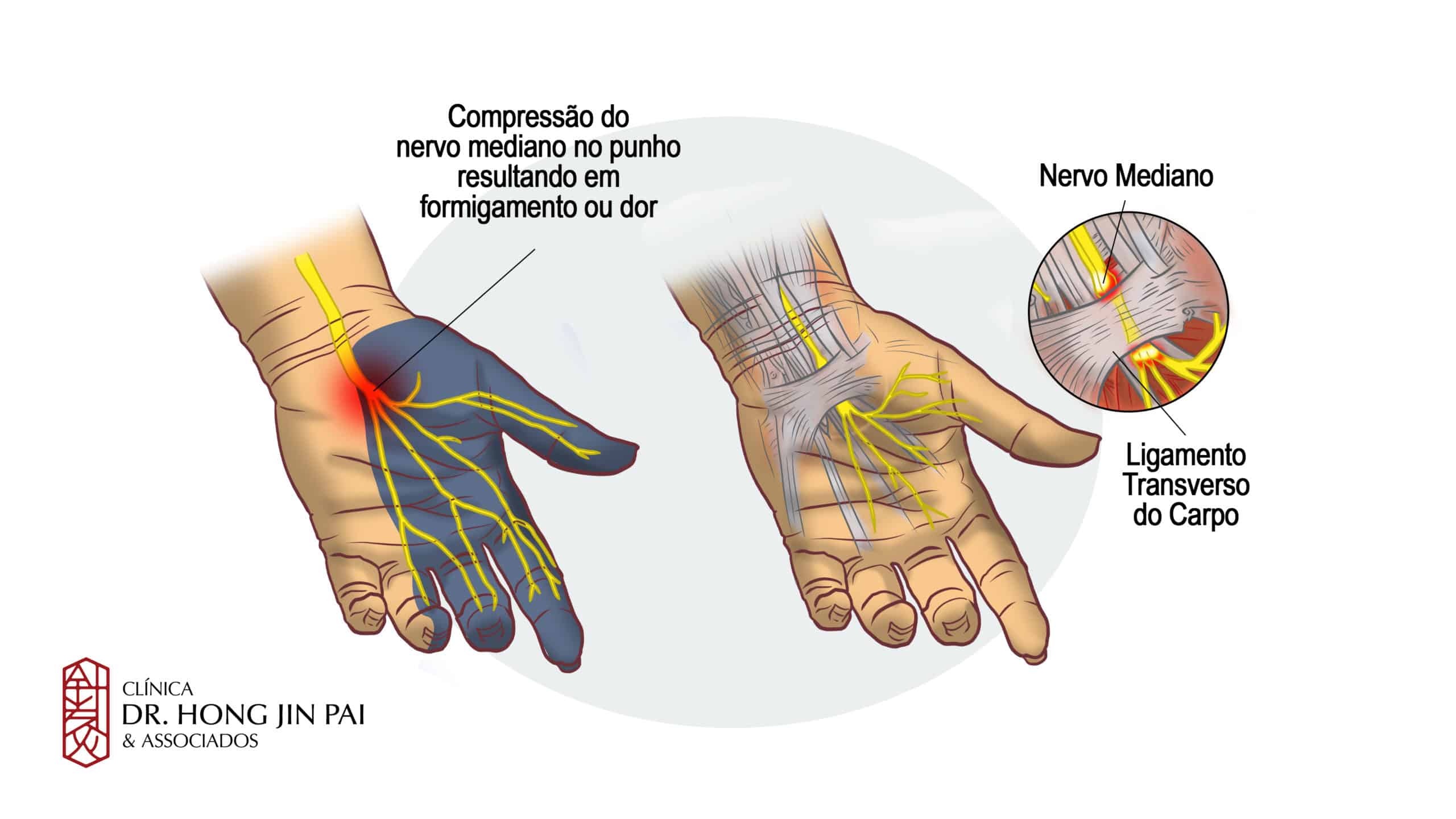 dor nas maos tunel do carpo