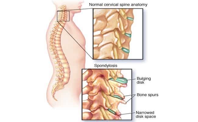 espondilose coluna vertebral